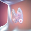 Understanding the 2022 WHO Thyroid Cancer Classification