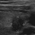 What Does Thyroid Cancer Look Like on Ultrasound?