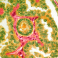 What Are the Chances of Thyroid Cancer Recurrence?