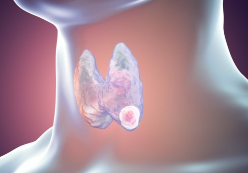 Understanding the 2022 WHO Thyroid Cancer Classification