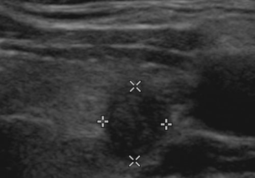 What Does Thyroid Cancer Look Like on Ultrasound?