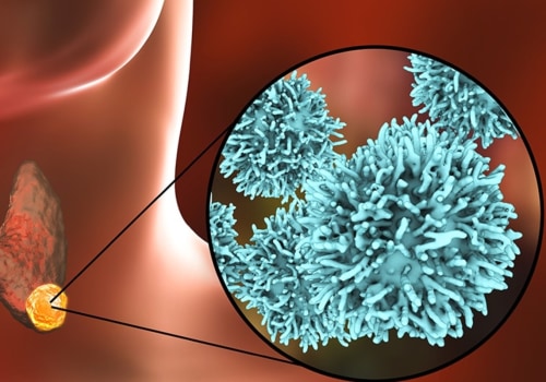 Which Thyroid Cancer Has the Best Prognosis?