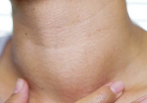 What Causes an Enlarged Thyroid Gland?