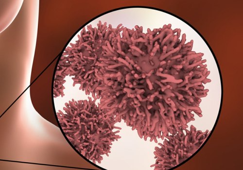 Can Thyroid Cancer Kill You? - An Expert's Perspective